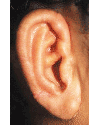 症例2耳介部分