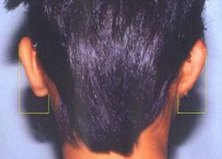 症例３耳垂残存型小耳症（右耳）背面