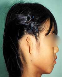 症例耳垂残存型　症例１　手術前
　