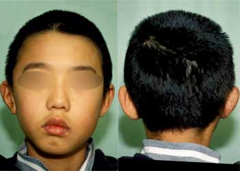 症例耳垂残存型　症例１　手術後 前面背面