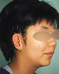 症例2 耳垂残存型小耳症（右耳）手術後