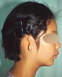 症例2 耳垂残存型小耳症（右耳）手術前