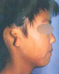 症例3 耳垂残存小耳症(右耳)手術前