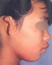 症例4 耳垂残存型小耳症（右耳 外耳道入口部および外耳道再建も含む）手術前