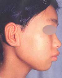 症例4 耳垂残存型小耳症（右耳 外耳道入口部および外耳道再建も含む）手術後
