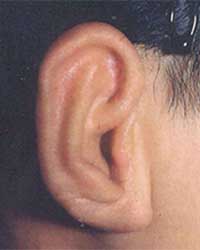 症例４耳垂残存型小耳症（右耳 外耳道入口部および外耳道再建も含む）手術後