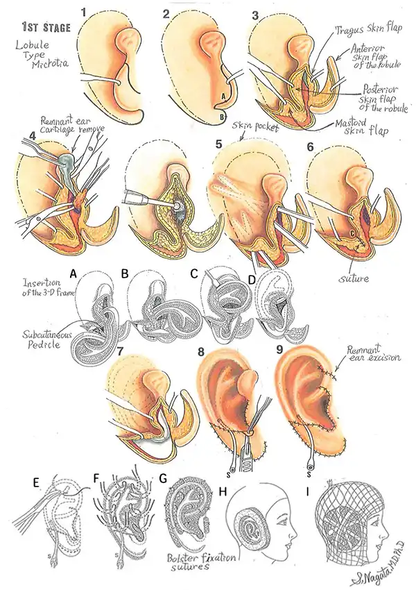 耳垂残存型小耳症の1回目の手術