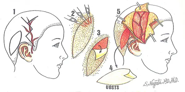 耳垂残存型小耳症の2回目の手術・耳立て手術