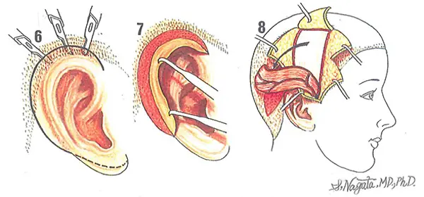 耳垂残存型小耳症の2回目の手術・耳立て手術2