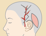 TPF、頭皮分層皮膚の使用