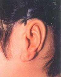 症例5 耳垂残存型小耳症左耳 1回目手術後