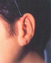 症例5 耳垂残存型小耳症左耳 2回目手術後