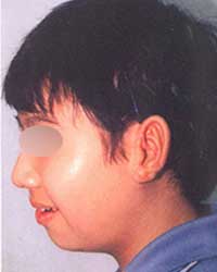 症例5 耳垂残存型小耳症左耳 2回目手術後