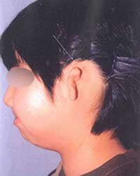 症例5 耳垂残存型小耳症左耳 手術前