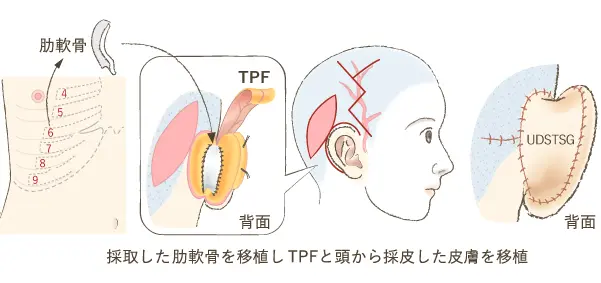 他の方法との違い 永田法による耳介挙上術の従来法との違い