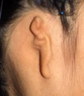 耳垂残存型