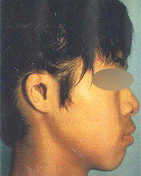 耳鼻科で巨大な穴をあけられた小耳症手術前
