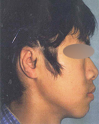耳鼻科で巨大な穴をあけられた小耳症手1回目手術後