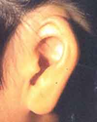 耳甲介型手術前