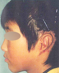 50%ローへアーラインを伴う耳垂残存型小耳症　　1回目手術後