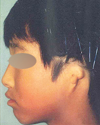 50%ローへアーラインを伴う耳垂残存型小耳症　手術前