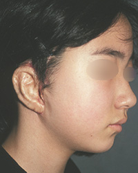 無耳症　症例１手術後