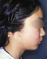 無耳症　症例１手術前