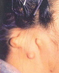 ローヘアーラインを伴う臨床的無耳症手術前
