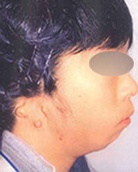 ローヘアーラインを伴う臨床的無耳症　手術前