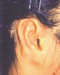 ローヘアーラインを伴う臨床的無耳症手術1回目手術後