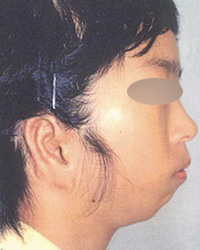ローヘアーラインを伴う臨床的無耳症　1回目手術後
