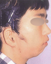 ローヘアーラインを伴う臨床的無耳症　手術後
