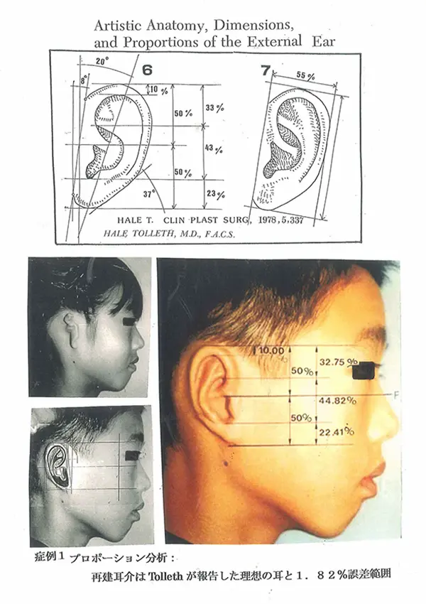 小耳症手術・再建耳介のプロポーション正確度判定1