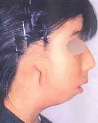 その他の小耳症 第1第2鰓弓（さいきゅう）症候群 1回目手術前