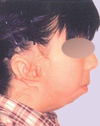 その他の小耳症 第1第2鰓弓（さいきゅう）症候群 1回目手術後