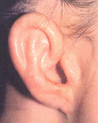 その他の小耳症 第1第2鰓弓（さいきゅう）症候群 2回目手術後