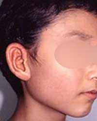 症例写真2小耳甲介型2回目手術後