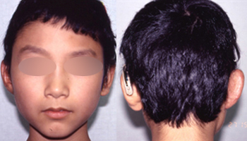 症例写真2小耳甲介型2回目手術後 前後