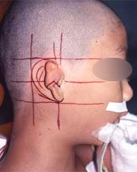 症例写真2小耳甲介型手術前