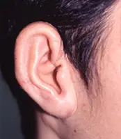 症例写真小耳甲介型2回目手術後