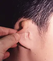 症例写真小耳甲介型2回目手術前