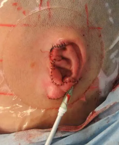 ３次元肋軟骨フレームを皮下ポケットへ移植して再建した耳介。