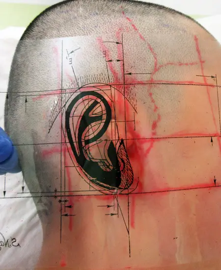 小耳甲介型小耳症（右耳）の肋軟骨移植術　透明フイルムに印刷した本人サイズの設計図を用いて 耳介の正常な場所と大きさを決定する。