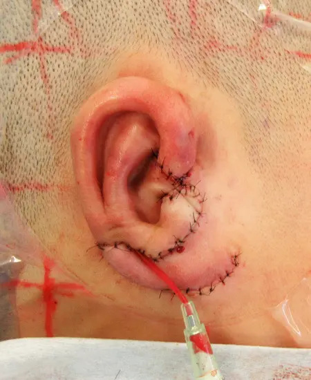 ３次元肋軟骨フレームを
　皮下ポケットへ移植して再建した耳介。