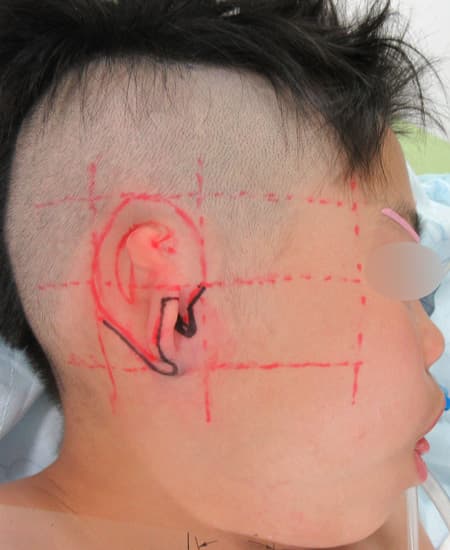 2023年5月9日 耳垂残存型小耳症（右耳）の肋軟骨移植術　デザイン