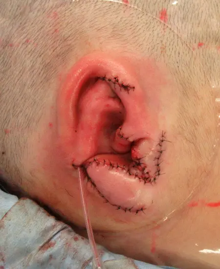 2023年5月9日 耳垂残存型小耳症（右耳）の肋軟骨移植術　
３次元肋軟骨フレームを
　皮下ポケットへ移植して再建した耳介。
