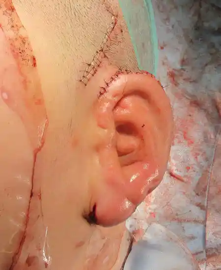 手術直後の耳の状態