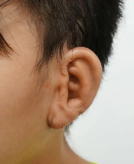 2回目手術後1カ月半の拡大した耳の状態