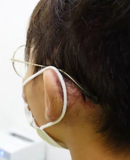 2回目手術後1カ月半のマスクをつけた状態。マスクはきちんと耳にかけられています。