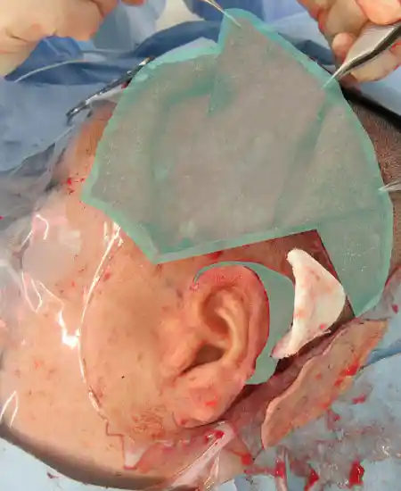 17/October/2023 耳垂残存型小耳症（左耳）の耳立て手術浅側頭筋膜（TPF）を挙上しています。